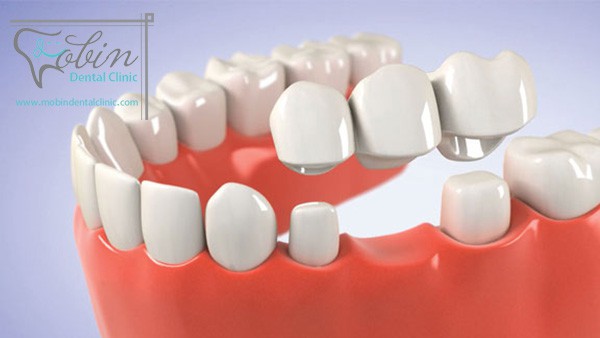 بریج دندان چیست و چه ویژگی هایی دارد؟